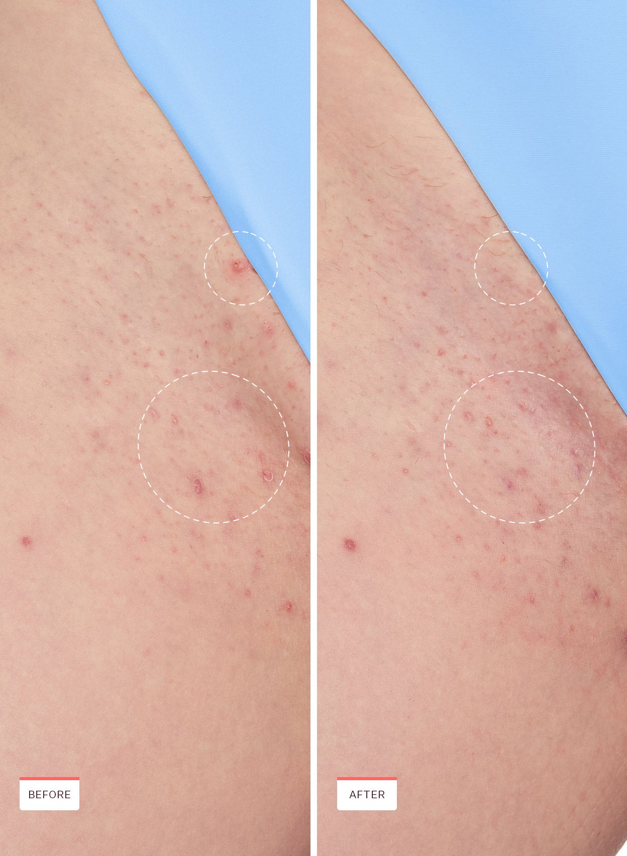 Smoothing Solution Ingrown Hair Treatment - Image 8