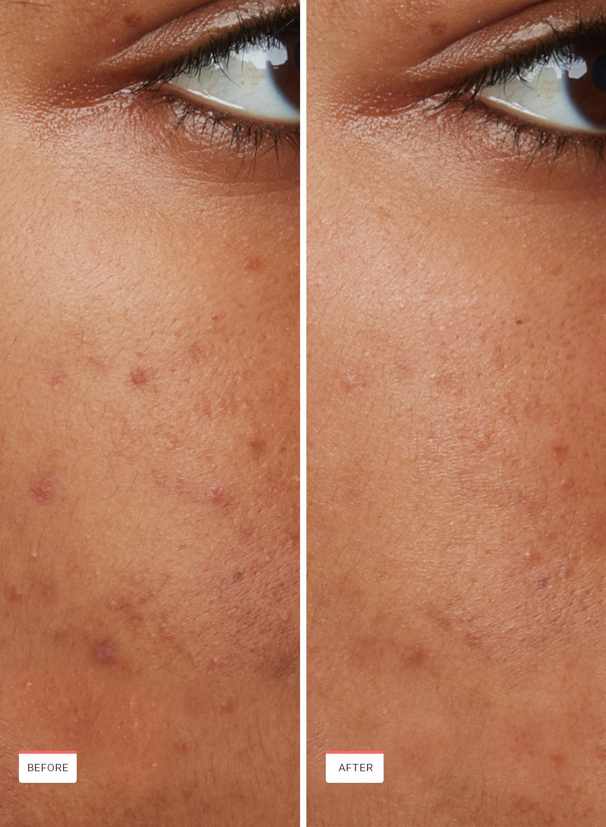 Acne Oil-Free Moisturizer - Image 7